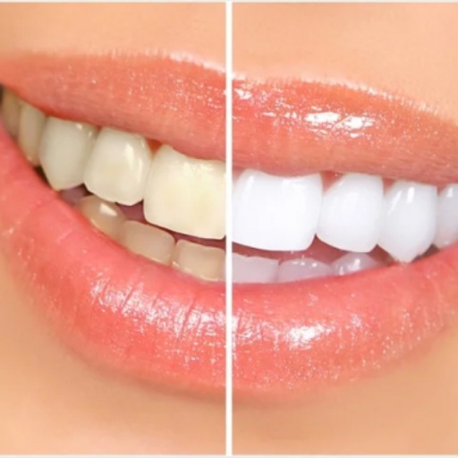 Whitening of Teeth